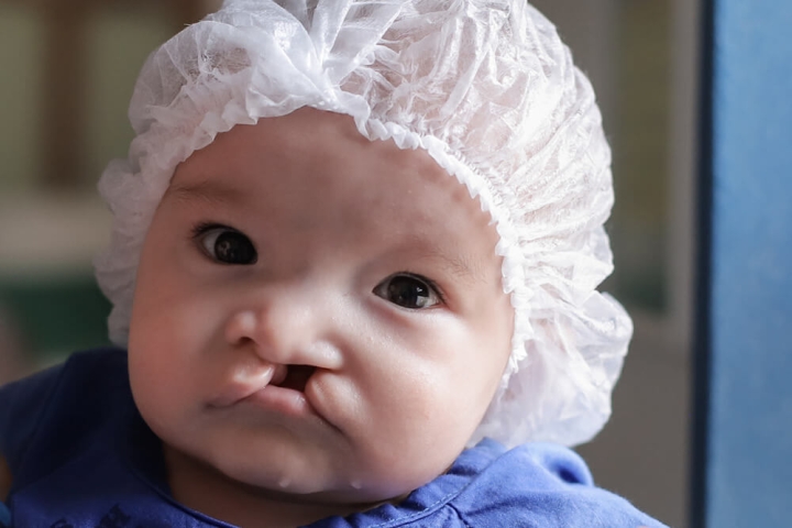 baby in need of cleft surgery