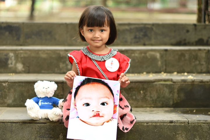 Khalisa holding a picture of herself before cleft surgery
