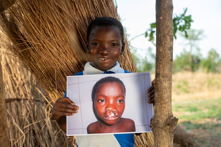 Akuya smiling while holding a picture of herself before cleft surgery