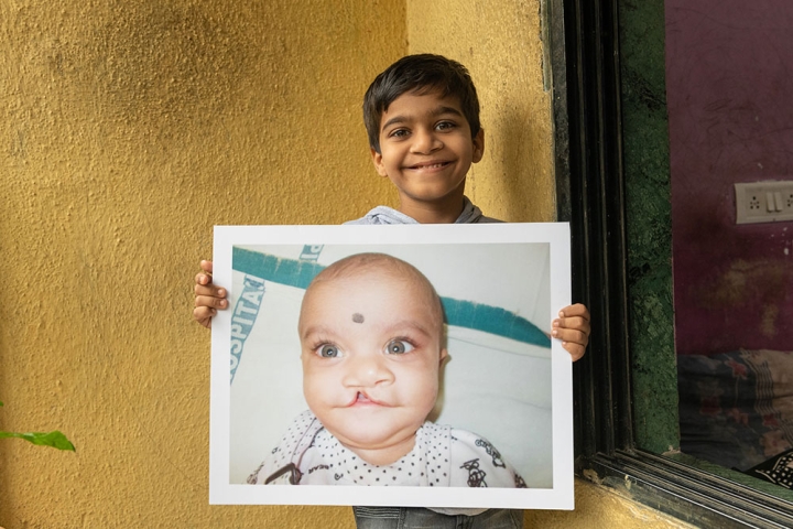 Samrat smiling with a picture of himself before cleft surgery