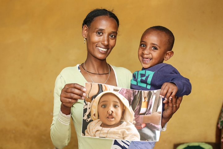 Yohanes and his mother smiling and holding a picture of him before cleft surgery