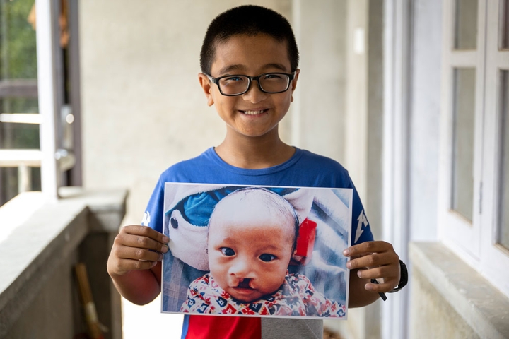 Jenious holding a picture of himself as a baby before cleft surgery