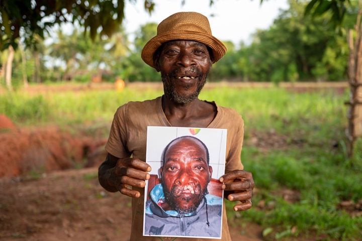 Edoh holding a picture of himself before cleft surgery