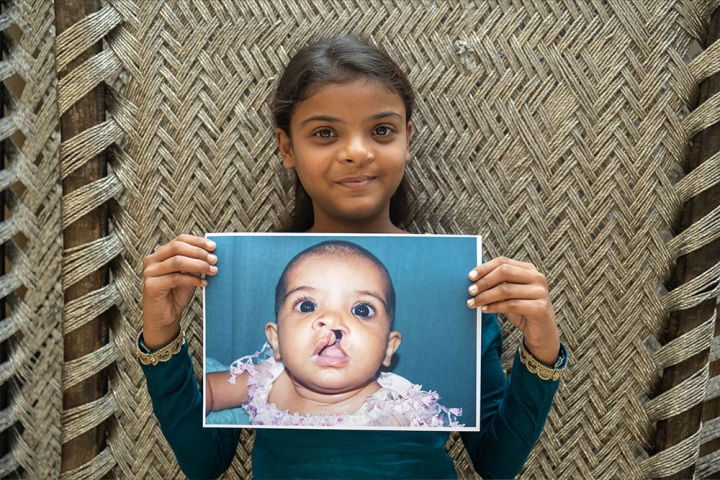 Paulwin smiling and holding a picture of herself before cleft surgery