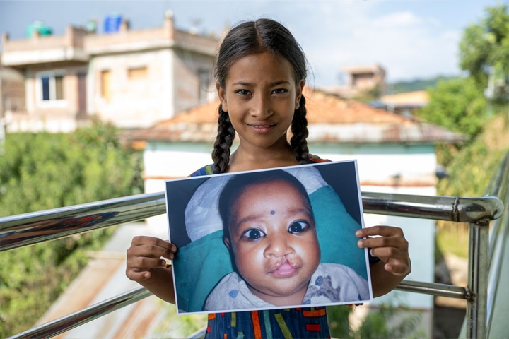 Simrik smiling and holding a picture of herself before cleft surgery