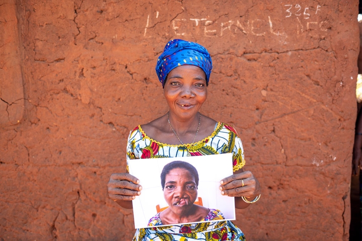 Adjoa smiling and holding a photo of herself before cleft surgery