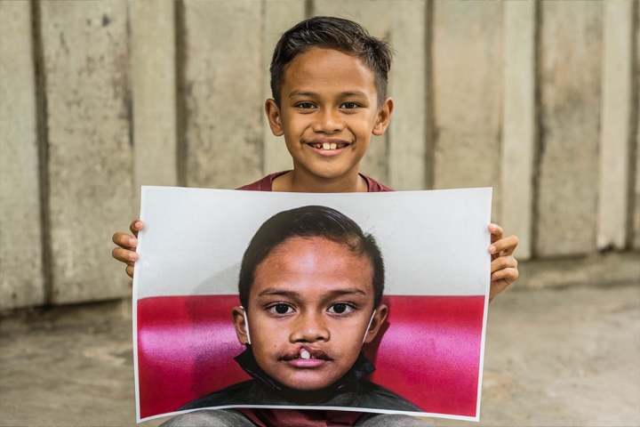 Zafran smiling and holding a picture of himself before cleft surgery