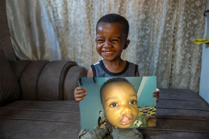 Joshua holding a picture of himself before cleft surgery