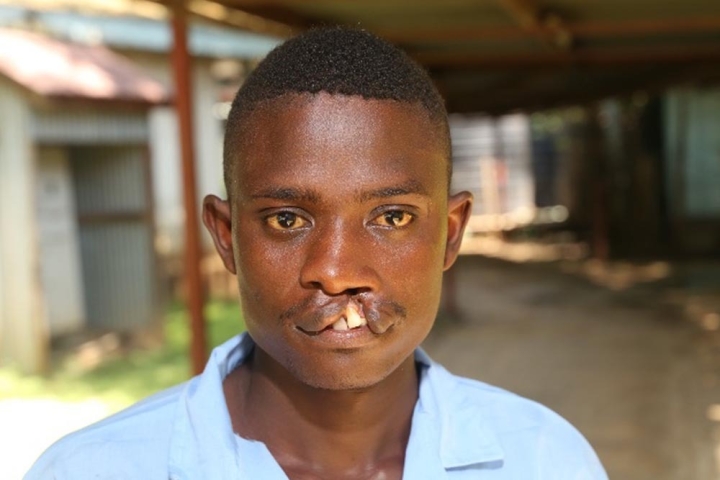 Oti before cleft surgery