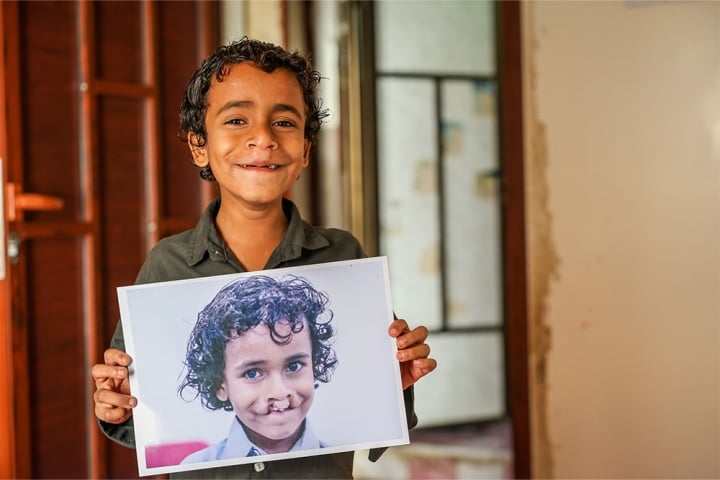 Bilal smiling, holding a picture of himself from before cleft surgery