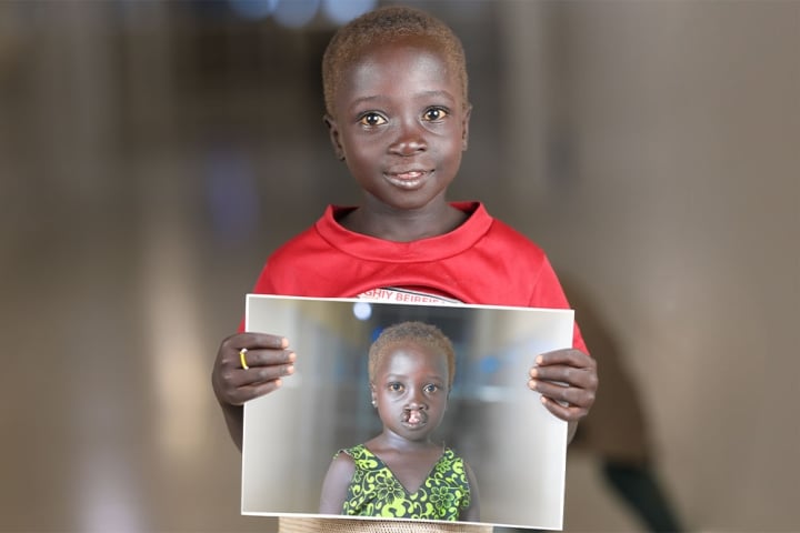 Nyanchiek smiling and holding a picture of herself before cleft surgery