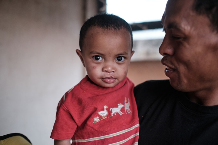 Eden smiling after cleft surgery