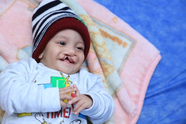 Noah laying on a blanket, smiling before cleft surgery