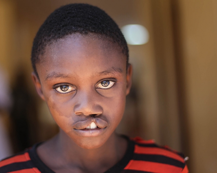 young man at school with an untreated cleft