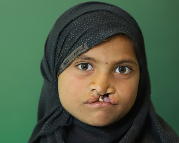 A girl from Pakistan with a cleft lip