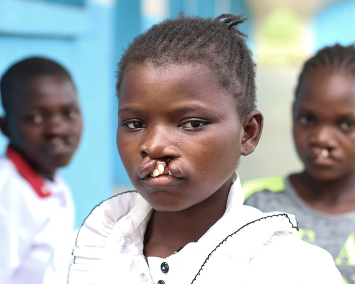 three children with cleft in DRC