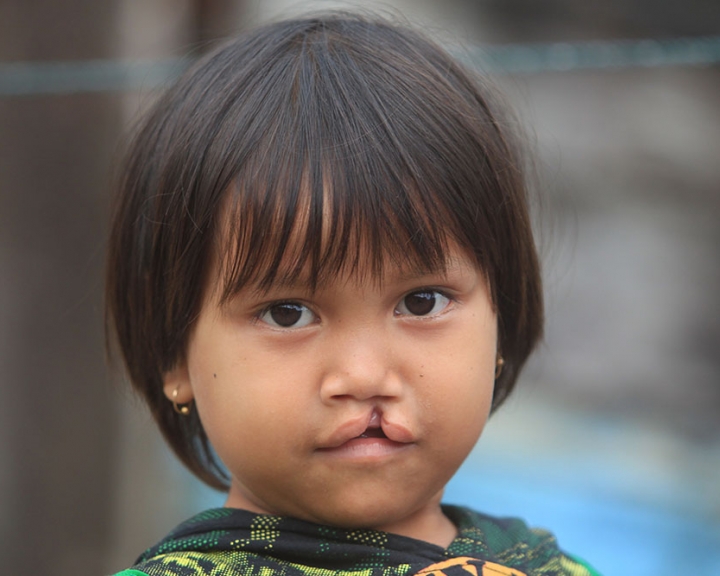 a girl with a cleft from Indonesia