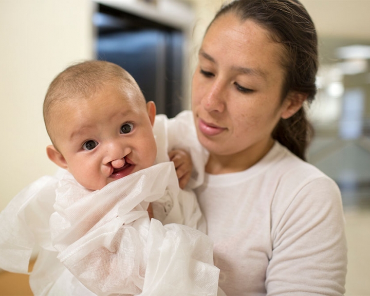 Mother holds her child with bilateral cleft lip