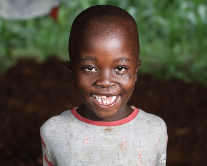 boy with treated cleft lip