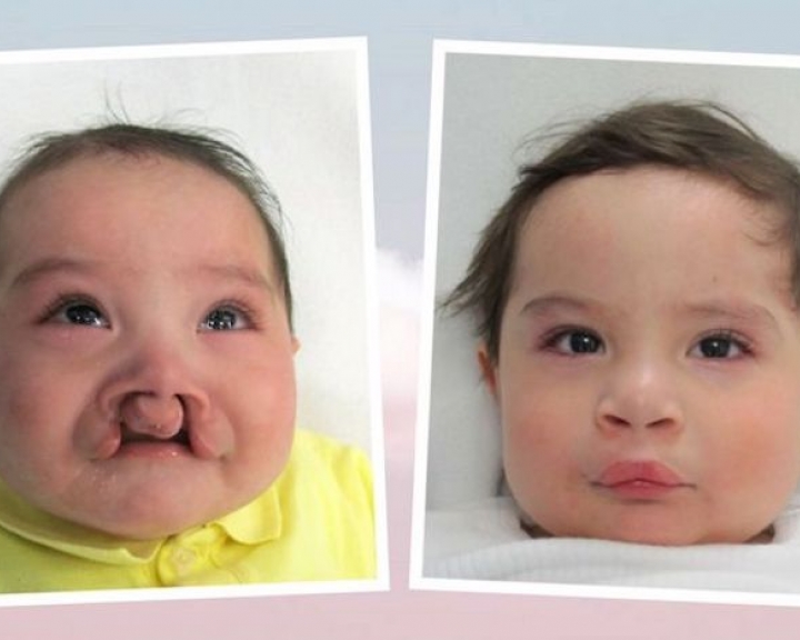 baby before and after cleft surgery