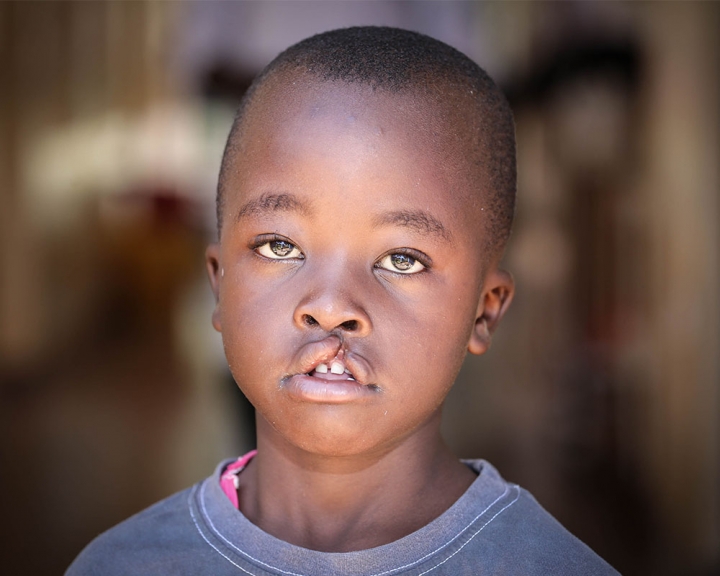 boy with cleft lip from Kenya