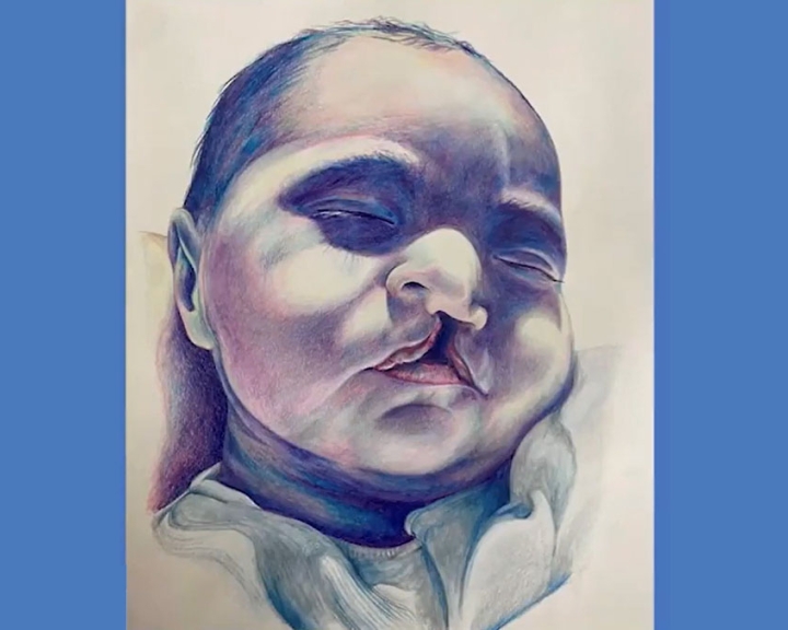 One of Katie Manning's cleft portraits