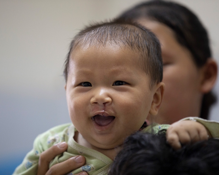 Smile Train Sustainable Model