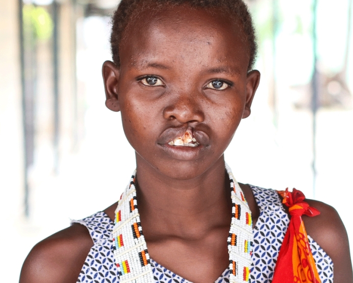 girl with cleft
