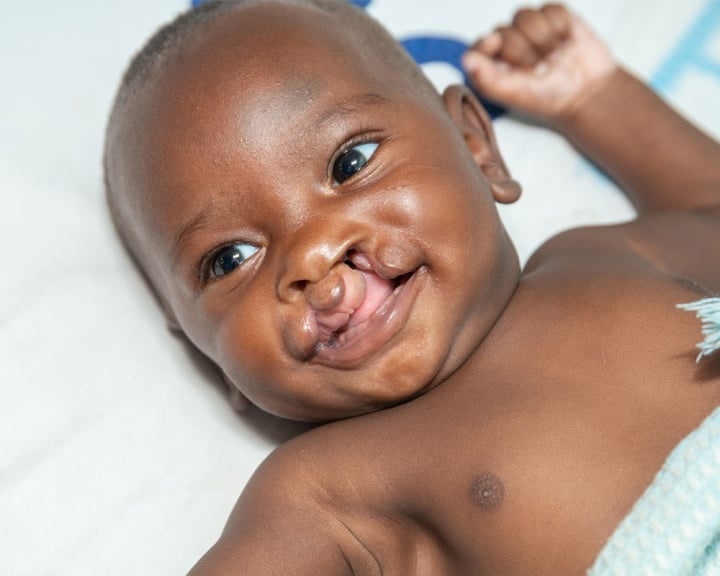 A Tanzanian baby smiling before cleft surgery