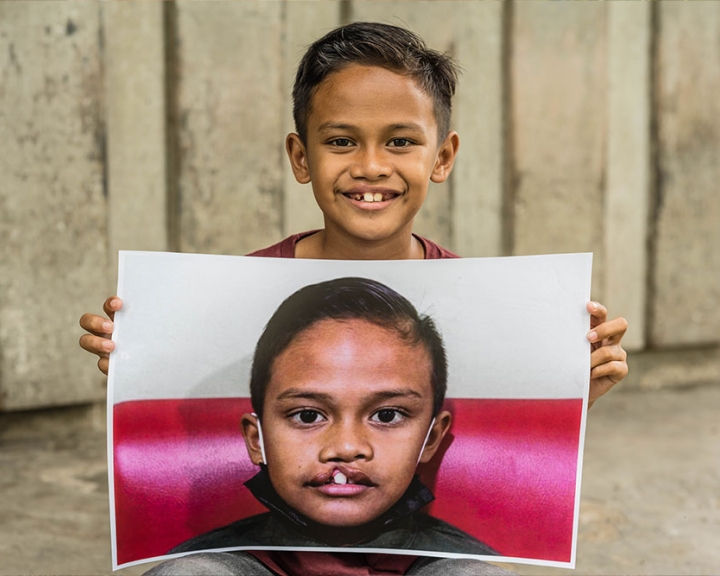 Zafran smiling and holding a picture of himself before cleft surgery