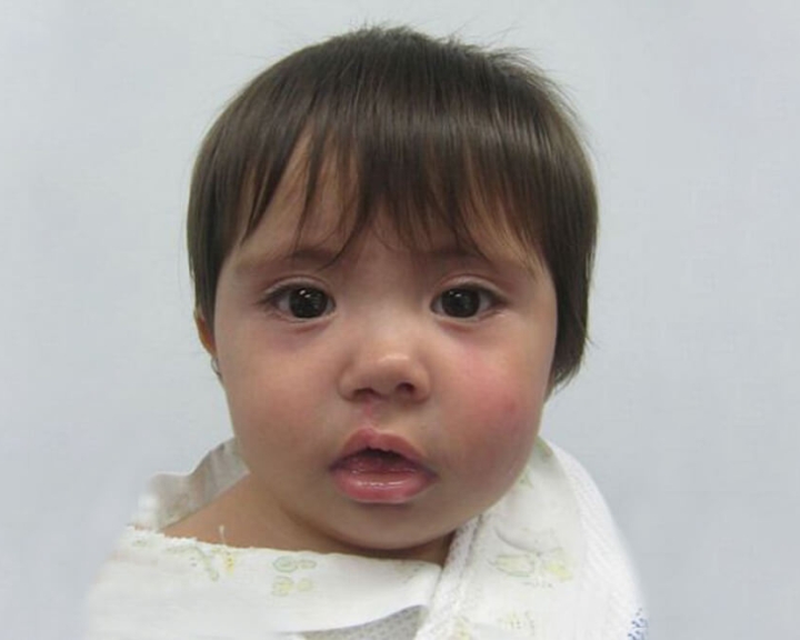 Milagros before cleft palate surgery