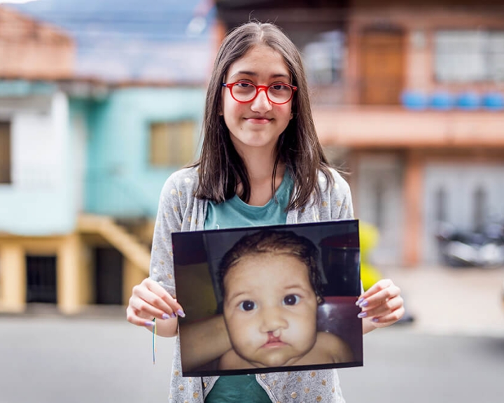 Smile Train patient holding before photo
