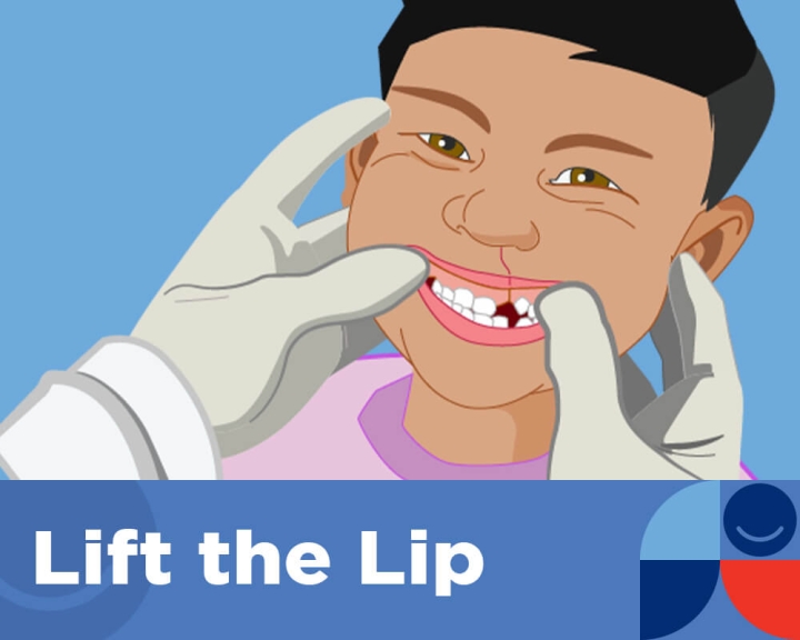 STOP - Lift the Lip
