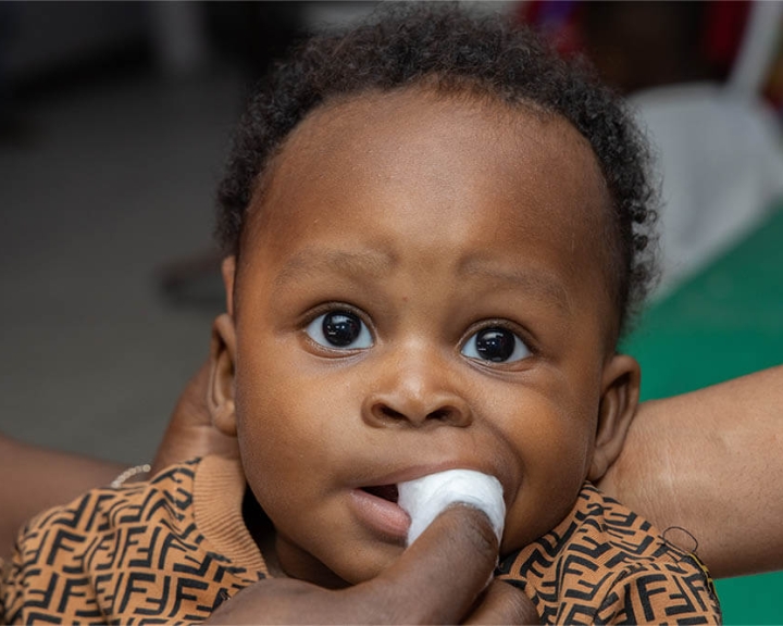 baby with cleft