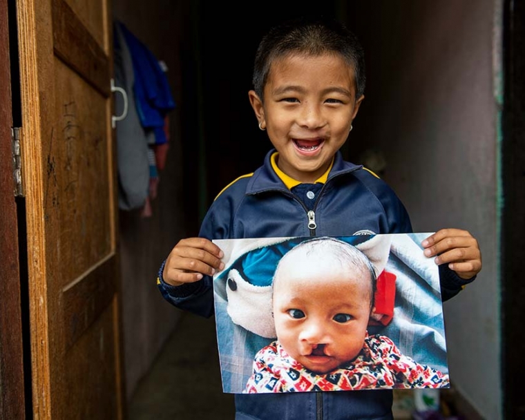 A boy from Nepal holding his before cleft surgery image