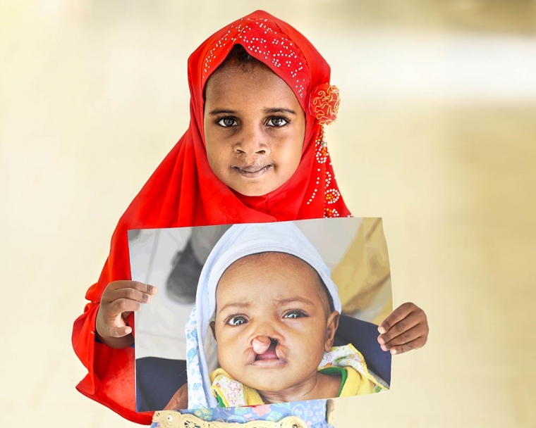 Aayan holds image of herself before cleft lip surgery