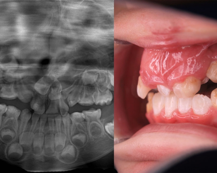 Neitan's teeth and orthodontic images