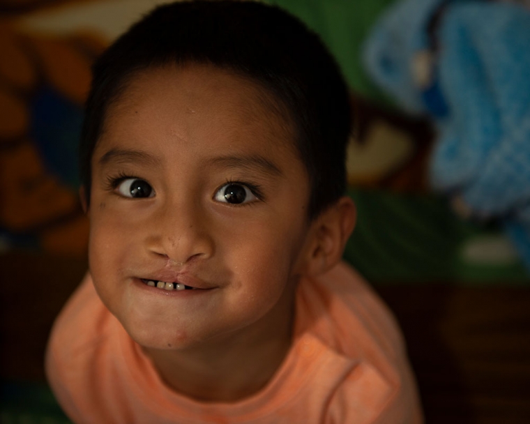 Anghelo looking at the camera showing off his cleft surgery.