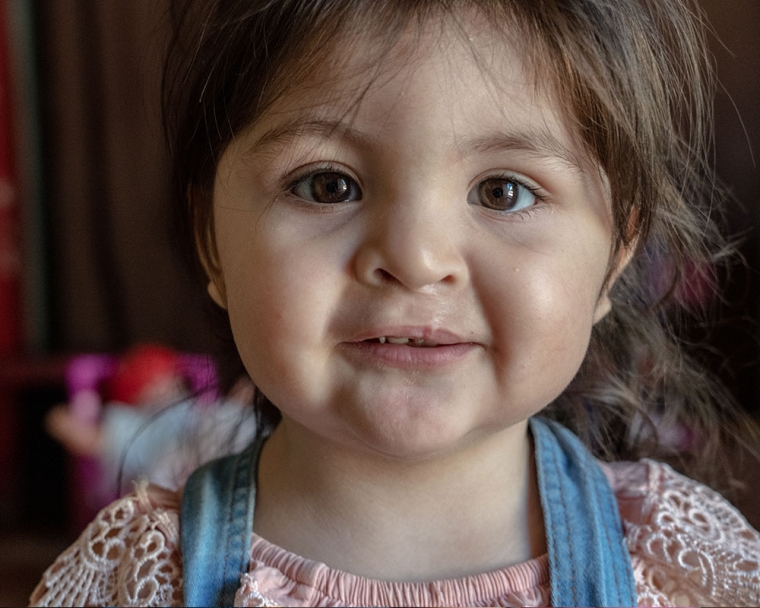 Close up of Luaxana after cleft surgery