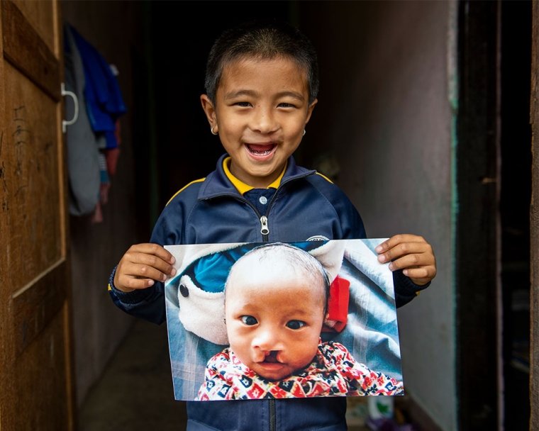 Jenious holding a picture of himself before cleft surgery