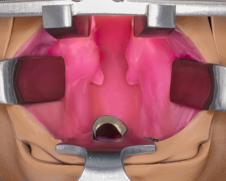 Cleft Palate Bottom