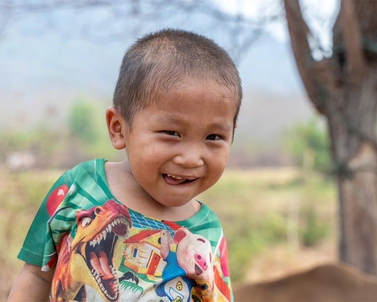 Jingtee smiling after cleft surgery