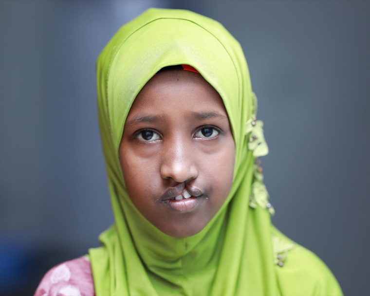 Maryan before cleft surgery