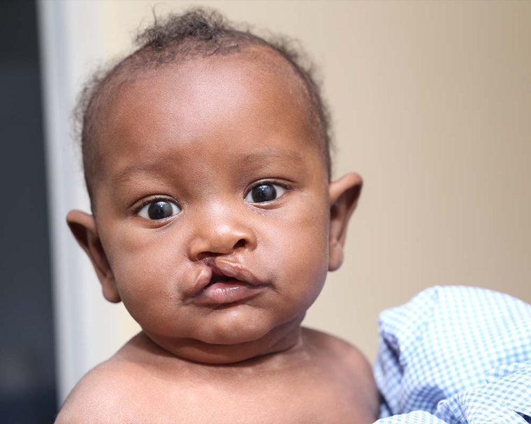Omar before cleft surgery