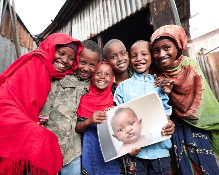 Omar smiling and holding a picture of himself before cleft surgery
