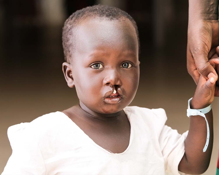 Jacob before cleft surgery