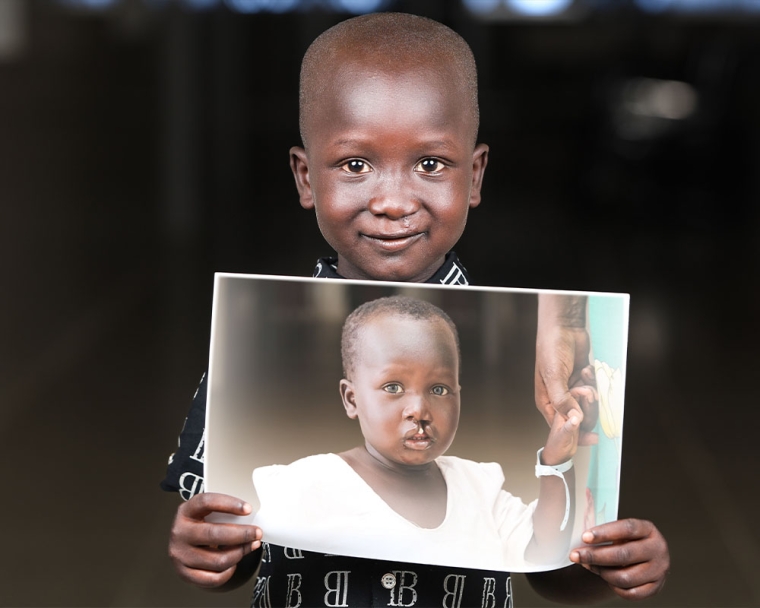 Jacob smiling and holding a picture of himself before cleft surgery