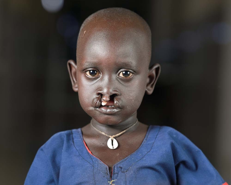 Machiek Majok before cleft surgery