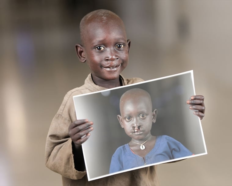 Machiek Majok smiling and holding a picture of himself before cleft surgery