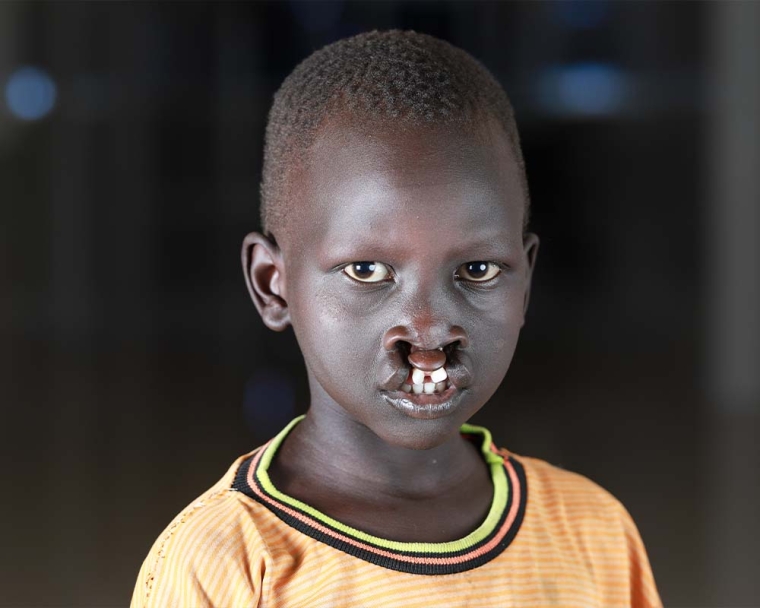 Machiek Makur before cleft surgery